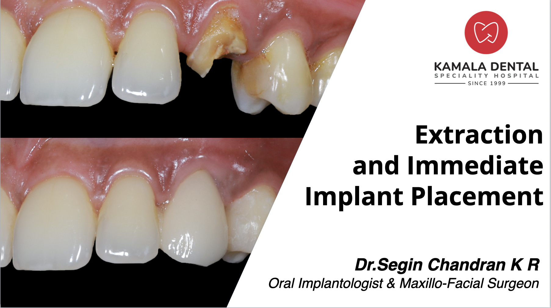 Immediate Implant Placement after Extraction